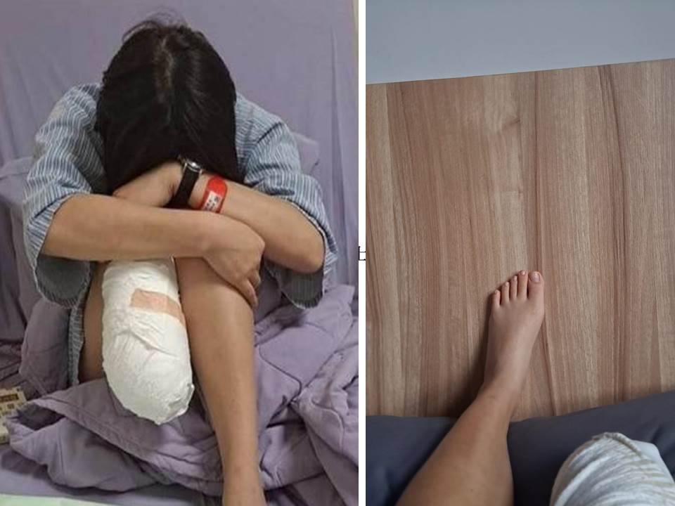 截肢女孩因公受傷導致截肢