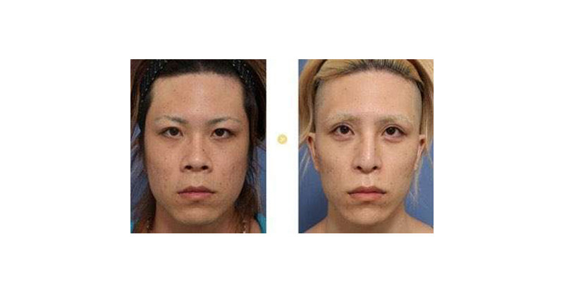 羅蘭整形前後差異，左邊為整形前，右邊為整形後。