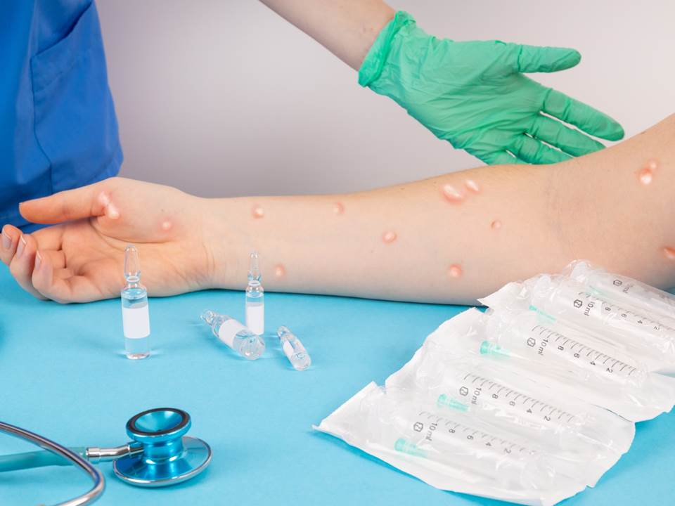 猴痘常見症狀有哪些？公費疫苗該怎麼預約？如何避免被猴痘傳染一次報你知